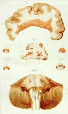 Anatomical drawing of lobes of the brain and MS lesions found by Charcot, one of the physicians mentioned in the article.