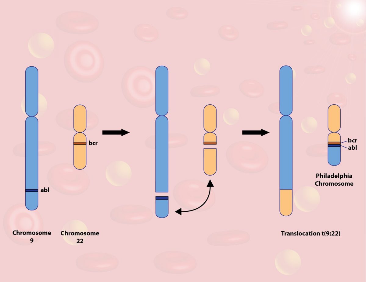 Cartoon depicting reciprocal translocation of chromosomes for Ph+ chronic myeloid leukemia.